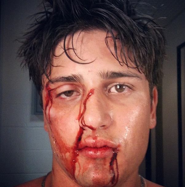 Daniel Rocha posta foto com o rosto todo machucado