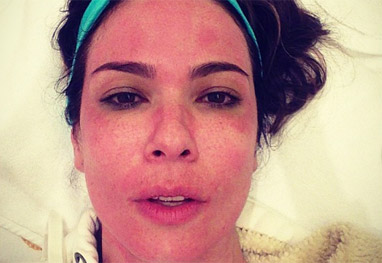 Luciana Gimenez fica com o rosto marcado após tratamento de beleza - Reprodução