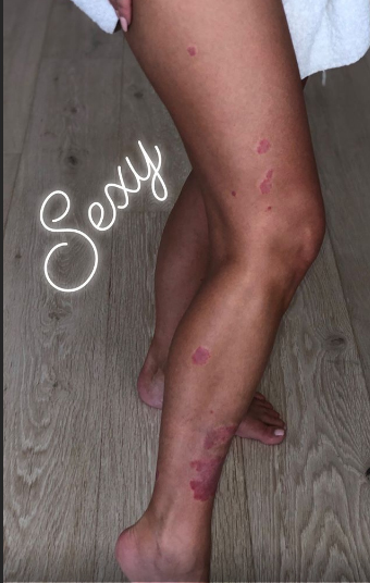 Kim Kardashian sofre com a doença dermatológica desde 2011