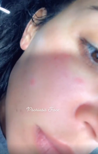 Kim Kardashian lida com a doença dermatológica há um tempo