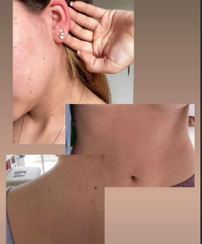 Klara Castanho faz alerta sobre automedicação: 'Acordei com o rosto inchado'