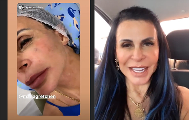 Gretchen retoca harmonização facial e mostra resultado na web