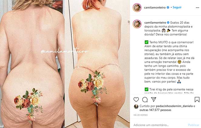Camila Monteiro mostrou resultado de cirurgia para retirar excesso de pele