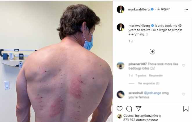 Ator mostra as costas após exame de alergia