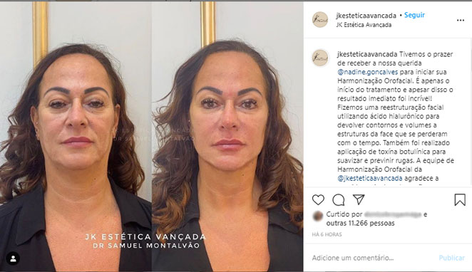 Nadine Gonçalves em 'antes e depois' do procedimento estético