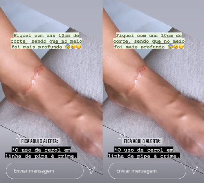 Vivian Amorim mostra corte no tornozelo, feito com linha de pipa com cerol