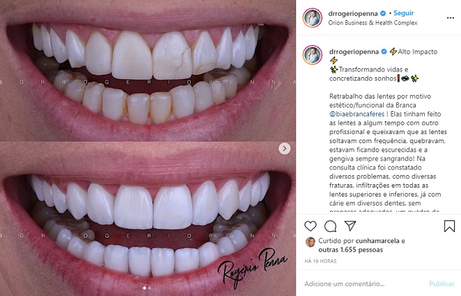 Bia e Branca Feres trocam lentes de contato nos dentes após problemas