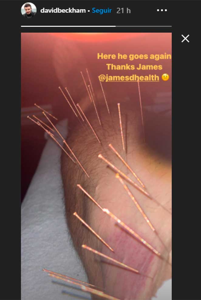 David Beckham mostrou perna cheia de agulhas de acupuntura