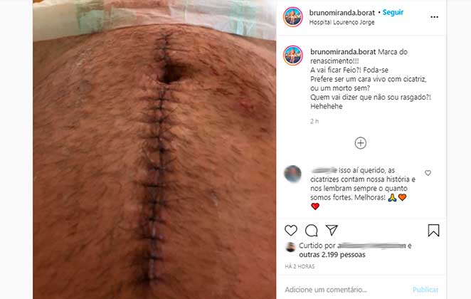Bruno Miranda, o Borat de Amor e Sexo, mostrou cicatriz pós-cirurgia