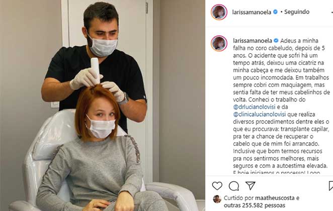 Larissa Manoela faz transplante capilar para corrigir falha