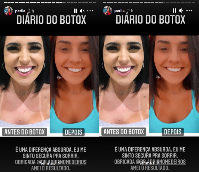 Perlla mostra antes e depois de aplicar botox