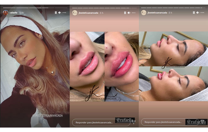 Rafaella Santos retoca procedimentos estéticos