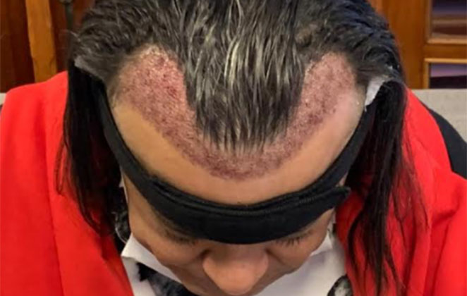 Frank Aguiar realizou um transplante capilar no interior paulista