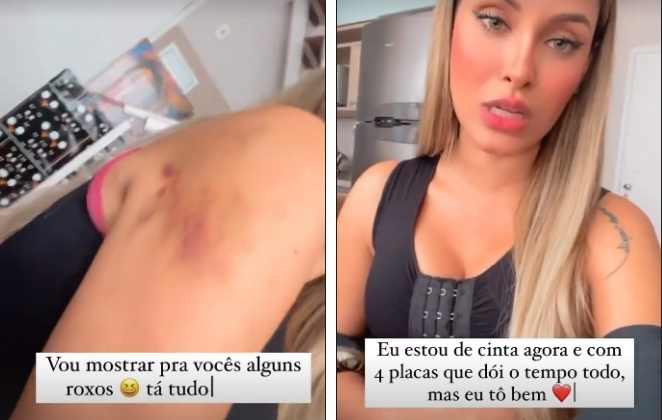 Sarah mostra hematomas e cinta pós-cirurgia