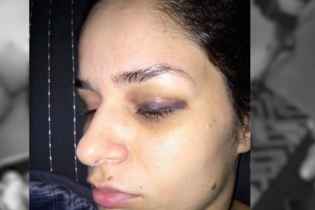 Pamella Holanda com  o olho roxo após agressão