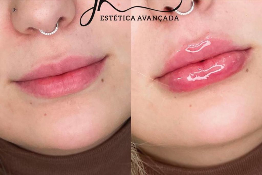 comparação dos lábios de viih tube após preenchimento labial