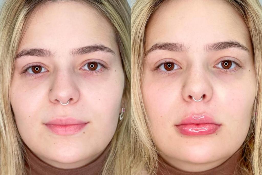 comparação dos lábios no rosto de viih tube após preenchimento labial