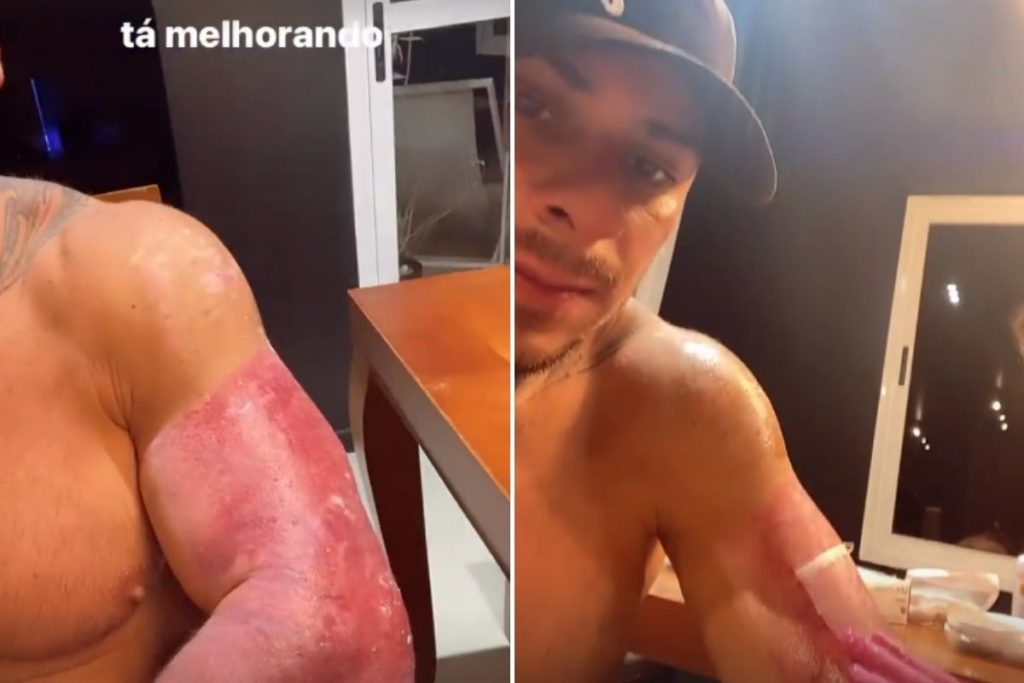 Leo Stronda mostra o braço durante recuperação após queimaduras por acidente doméstico