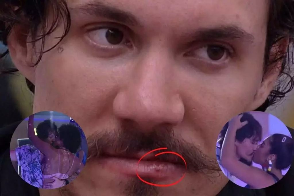 Eliezer com herpes no BBB22