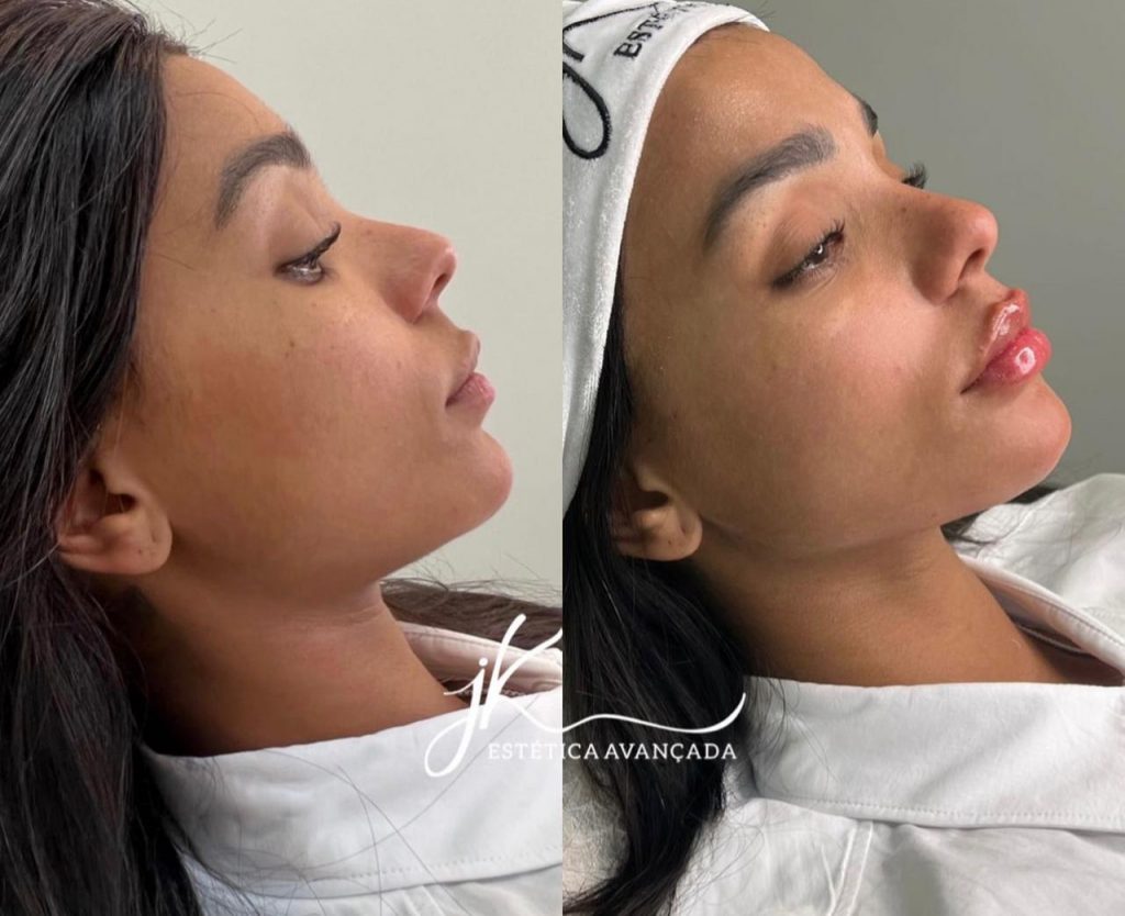 Antes e depois harmonização facial de Brunna Gonçalves