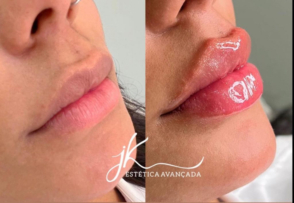 Antes e depois preenchimento labial de Brunna Gonçalves