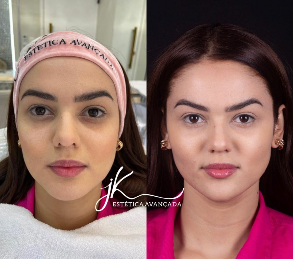 Eslovênia, do BBB22, mostra antes e depois de harmonização facial