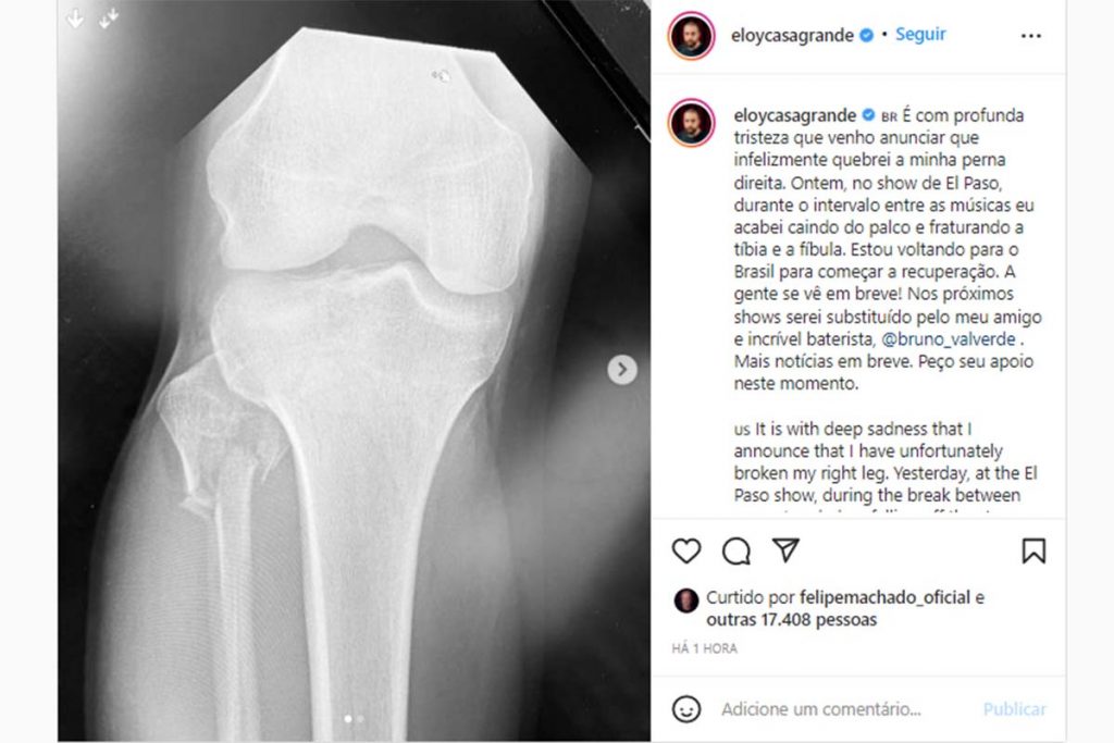 publicação de eloy casagrande no instagram sobre perna quebrada