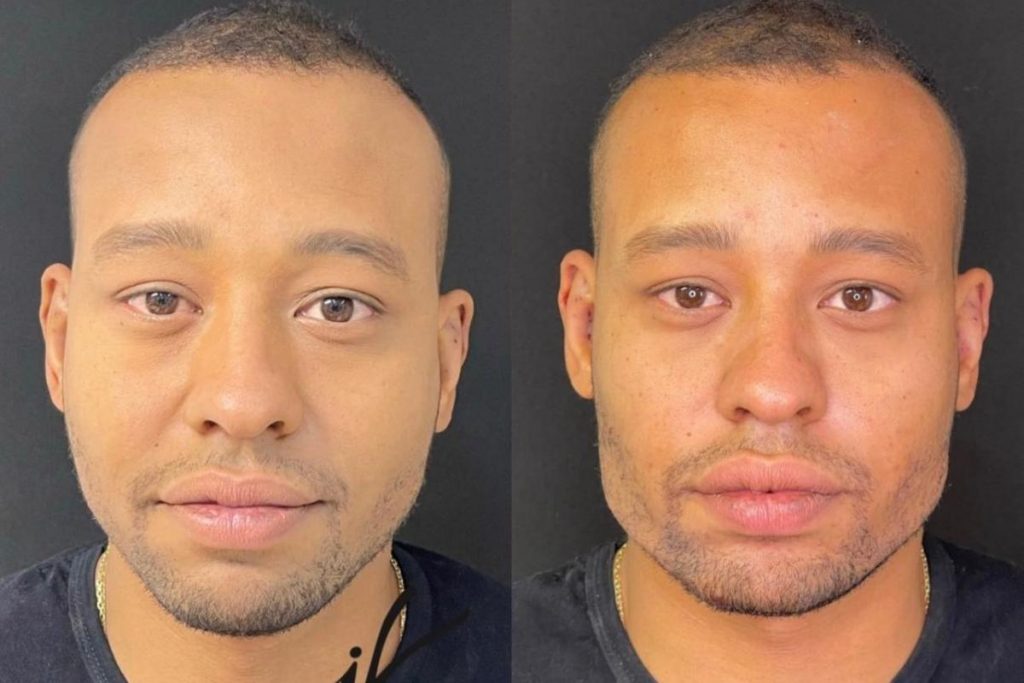 Antes e Depois de harmonização facial do ator Mussunzinho