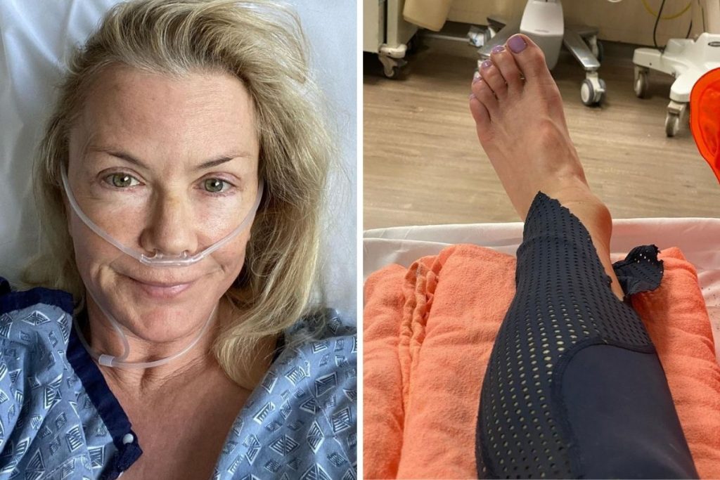 Katherine Lang tira foto do pé quebrado