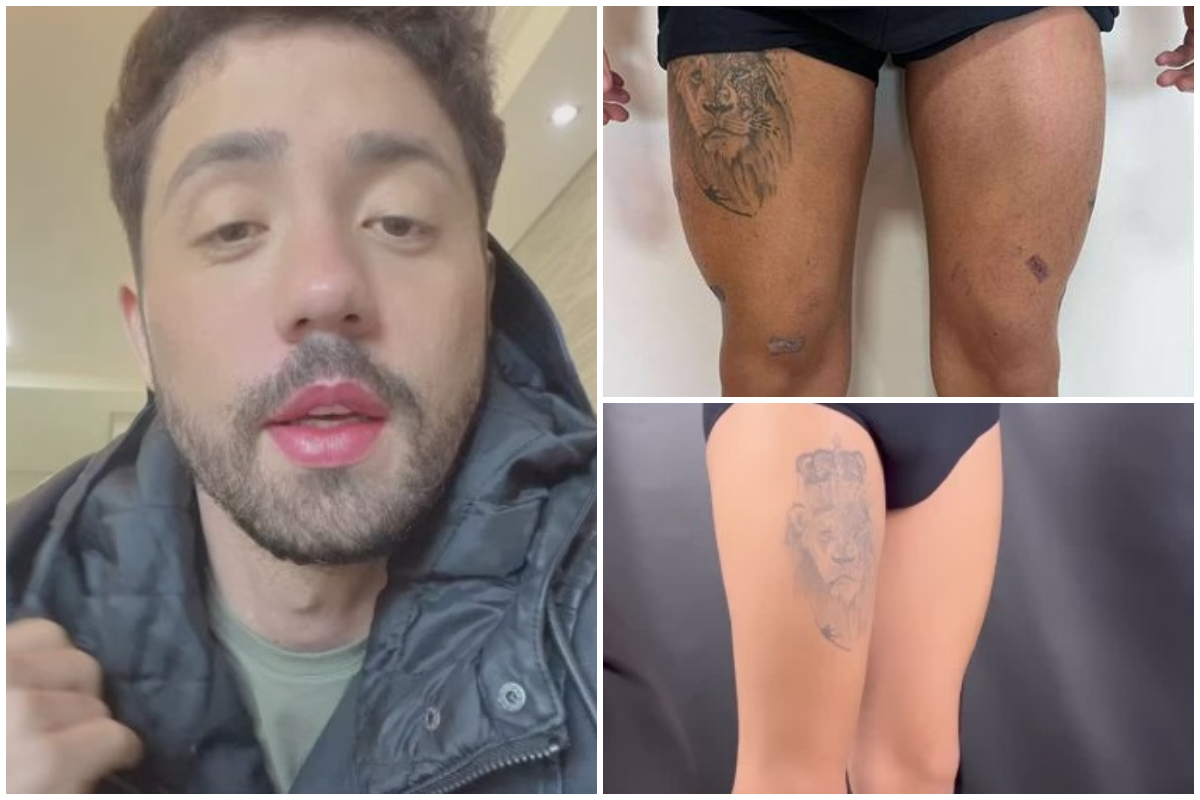 Rico Melquiades mostra antes e depois de procedimento nas pernas e bumbum