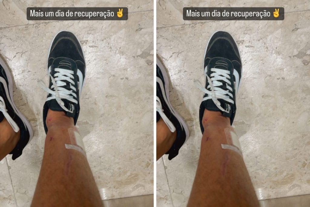 Rodrigo Mussi mostra cicatrizes pela primeira vez após acidente de carro