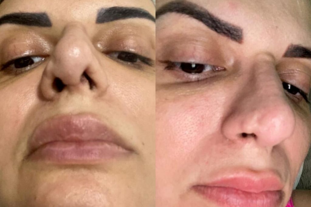 Resultado da cirurgia de rinoplastia mal feita e não autorizada, na empresária Carol Raggi