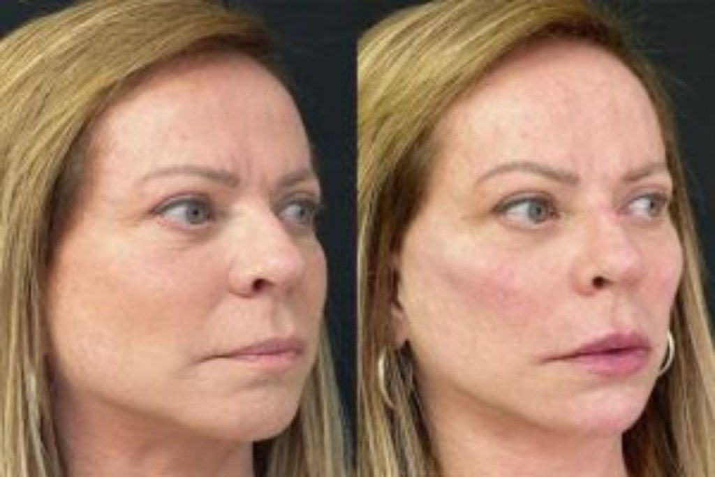 Christina Rocha passou por procedimento estéticos