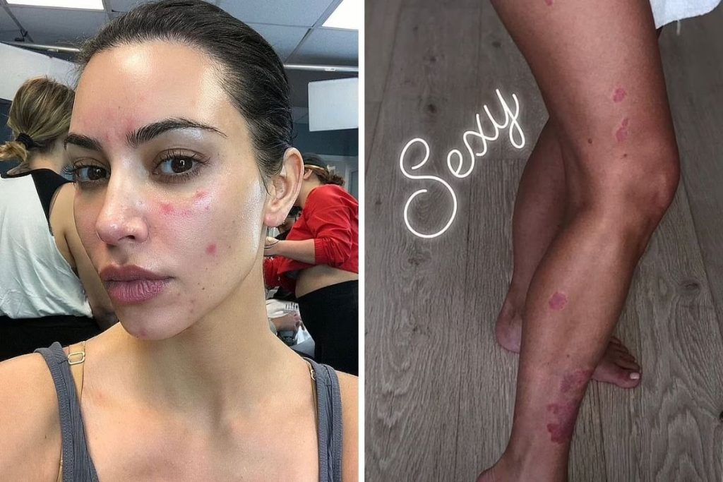 Kim Kardashian quando teve a primeira crise de psoríase