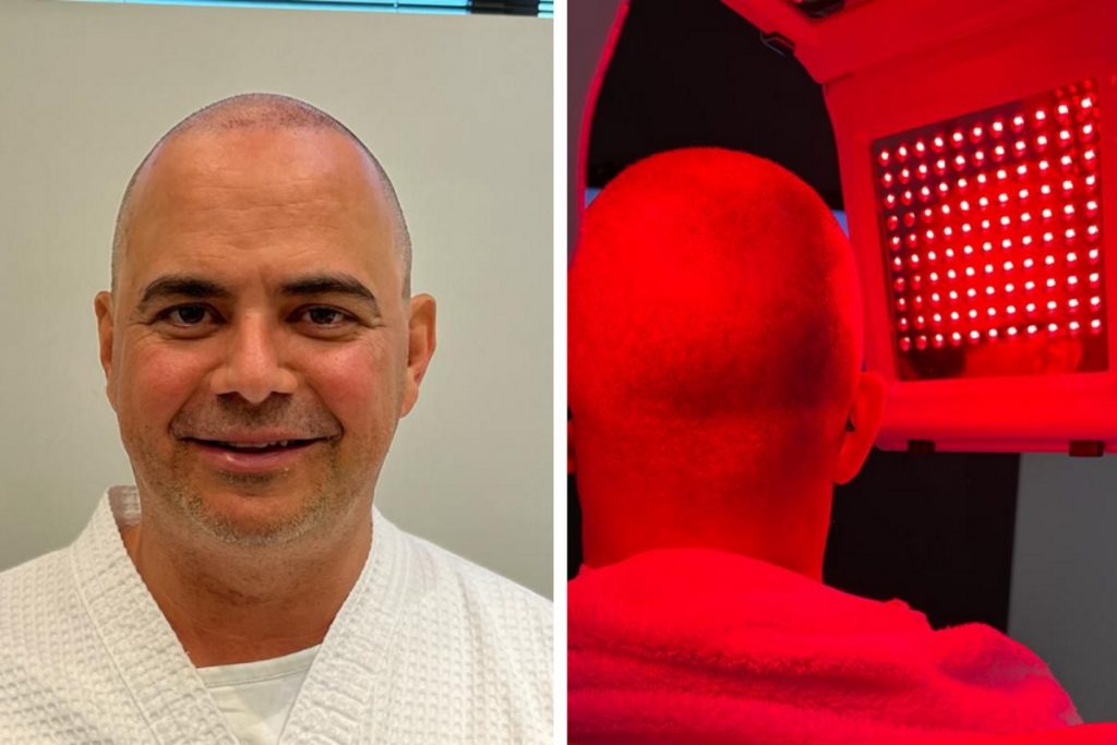 Marvio Lucio transplante capilar