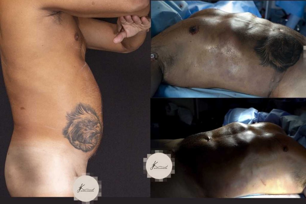 antes e depois de esdras de souza e gretchen fazerem cirurgia de lipo hd renuvium