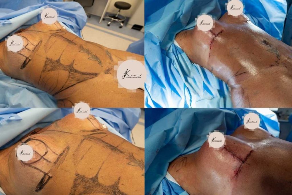 antes e depois de esdras de souza fazer cirurgia de lipo hd renuvium