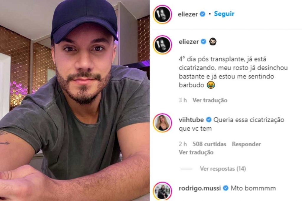 Postagem no Instagram Eliezer mostrando resultado de cirurgia de transplante de barba e cabelo