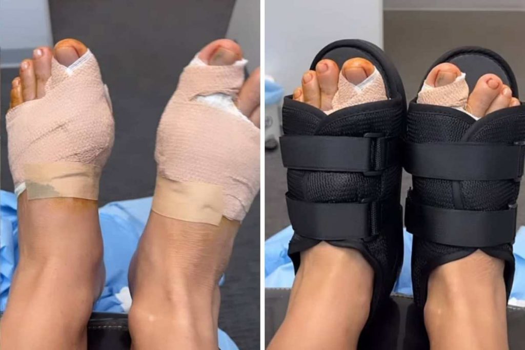 Zilu Godói mostra pés enfaixados após cirurgia