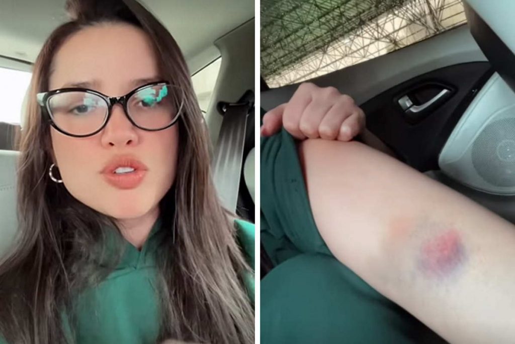 Juliette Freire mostra hematoma