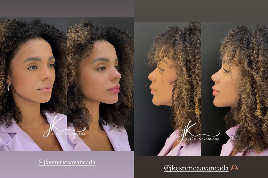 Brunna Gonçalves mostra antes e depois de harmonização facial
