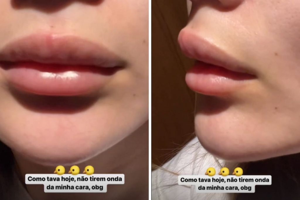 Post mostrando a boca da ex-BBB Eslovênia com toda inchada