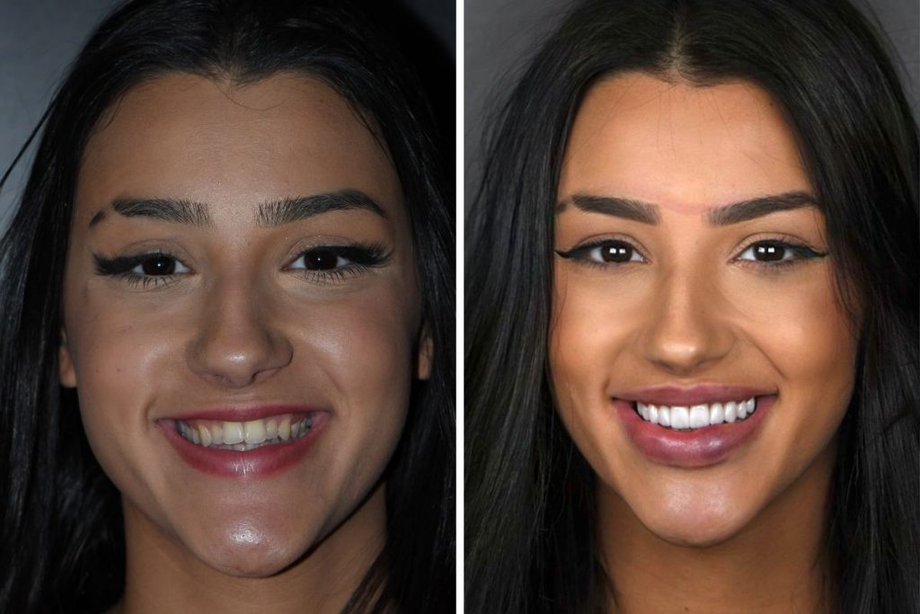 Bia Miranda antes e depois dos procedimentos estéticos