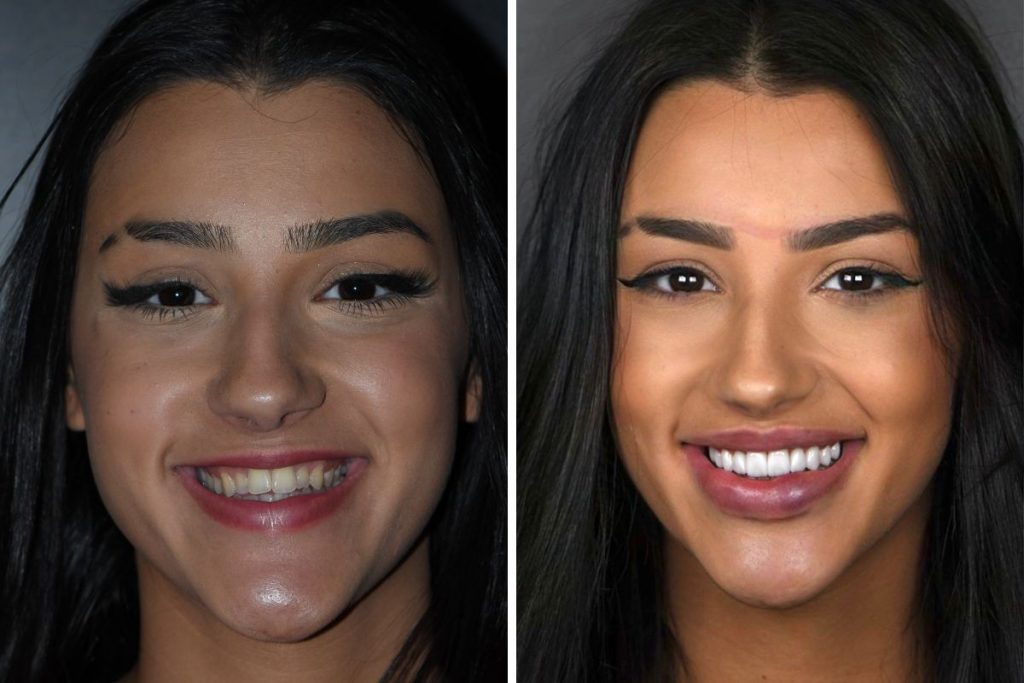 Bia Miranda antes e depois dos procedimentos estéticos