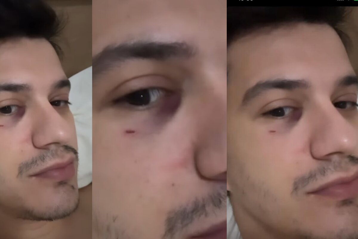 Sertanejo Hugo fica com olho roxo após ser atingido por celular arremessado por fã