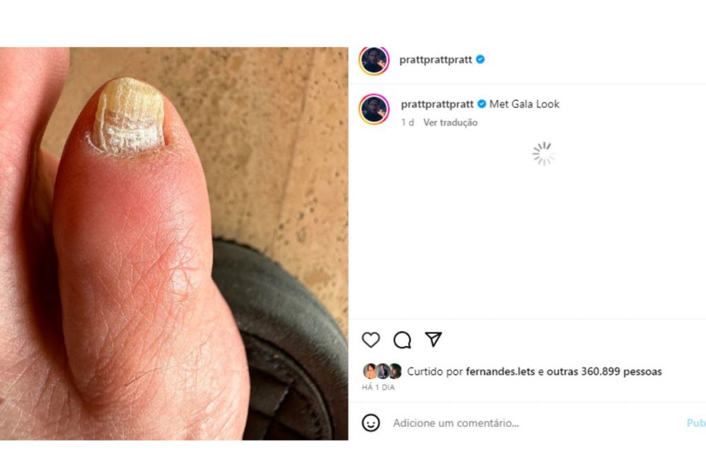 unha do pé de chris pratt