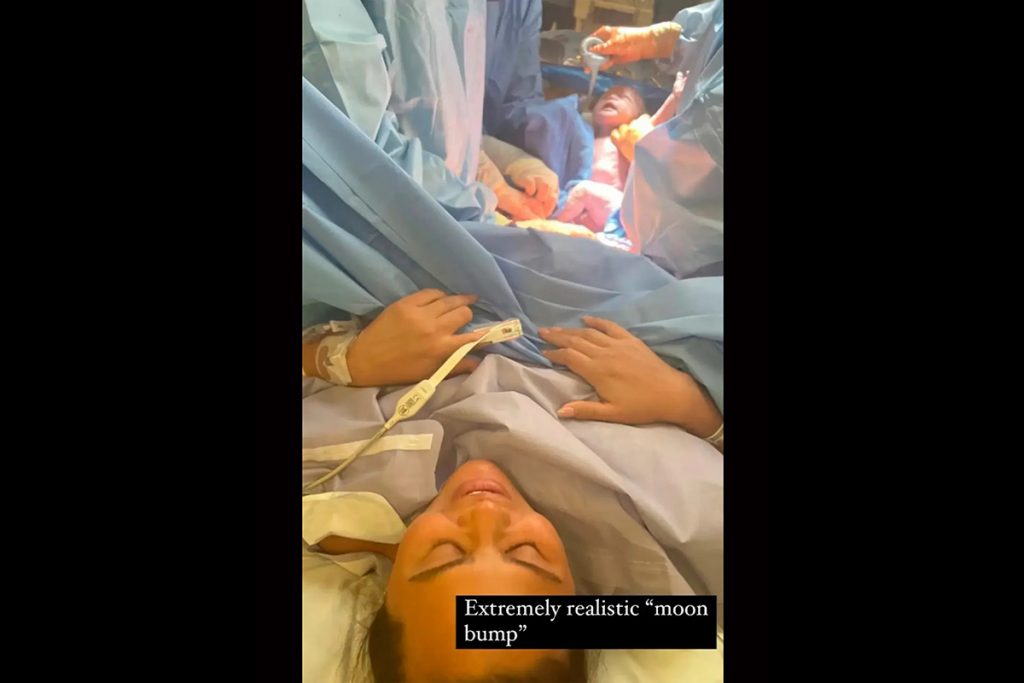 Chrissy Teigen mostra foto de cesárea para rebater acusações de ter fingido gravidez