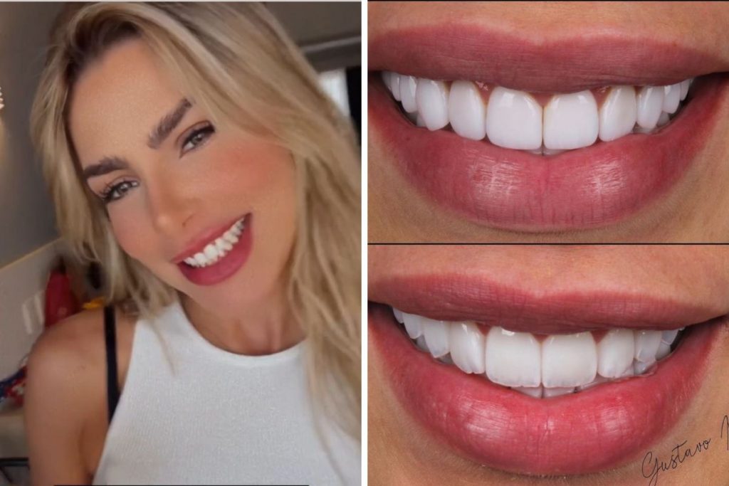 Erika Schneider em um antes e depois das lentes de contato nos dentes