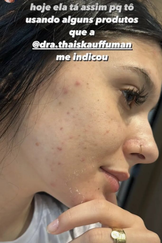 Ana Castela mostra espinhas