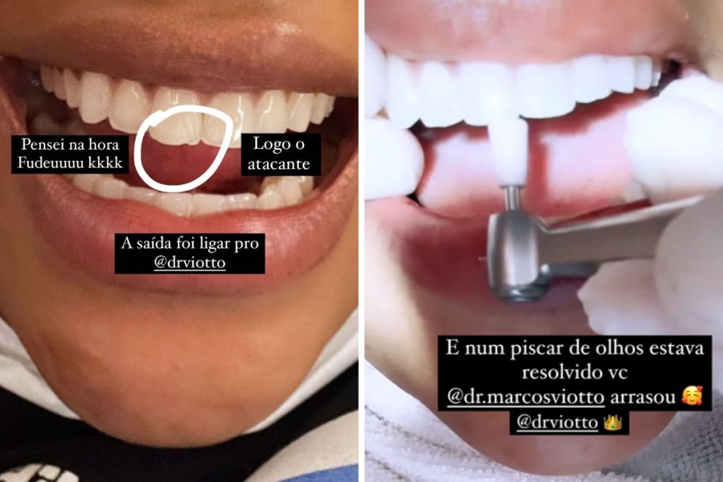 Ludmilla mostra antes e depois do dente